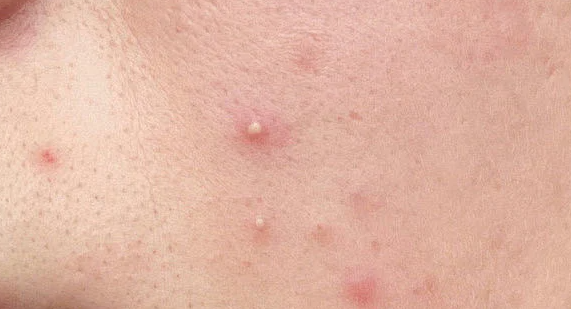 近年來祛痘類功效護膚品發(fā)展如何？